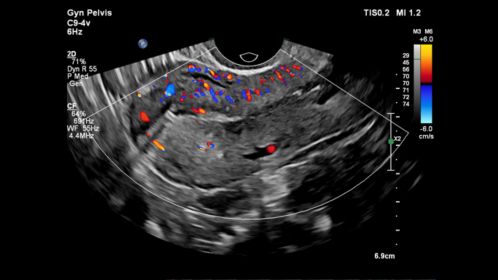 Gyn Pelvis ultrasound image shown with color flow using C9-4v transducer