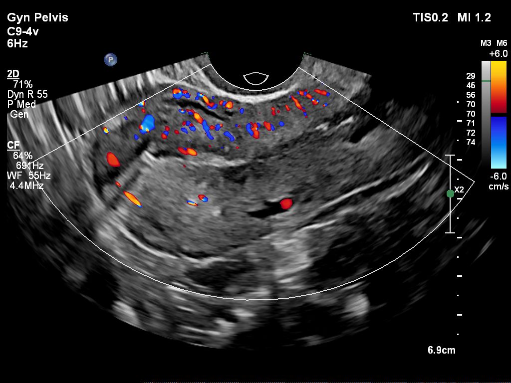 Gyn Pelvis ultrasound image shown with color flow using C9-4v transducer