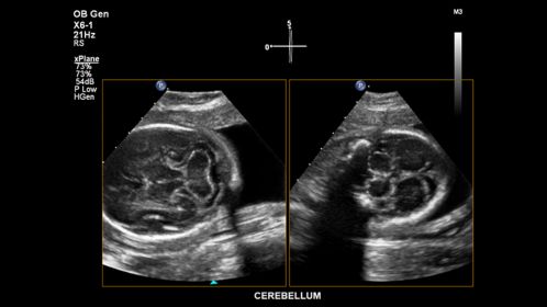 Cerebellum