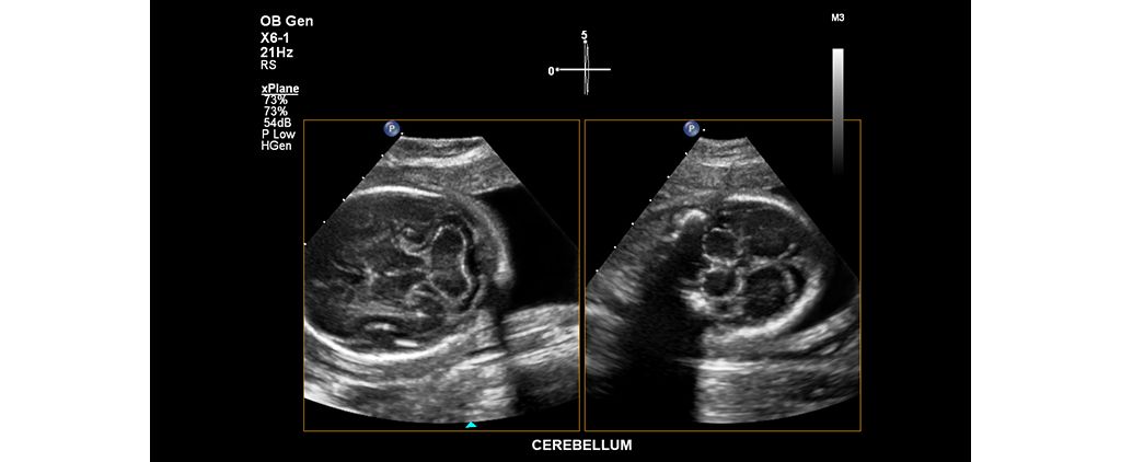 Cerebellum