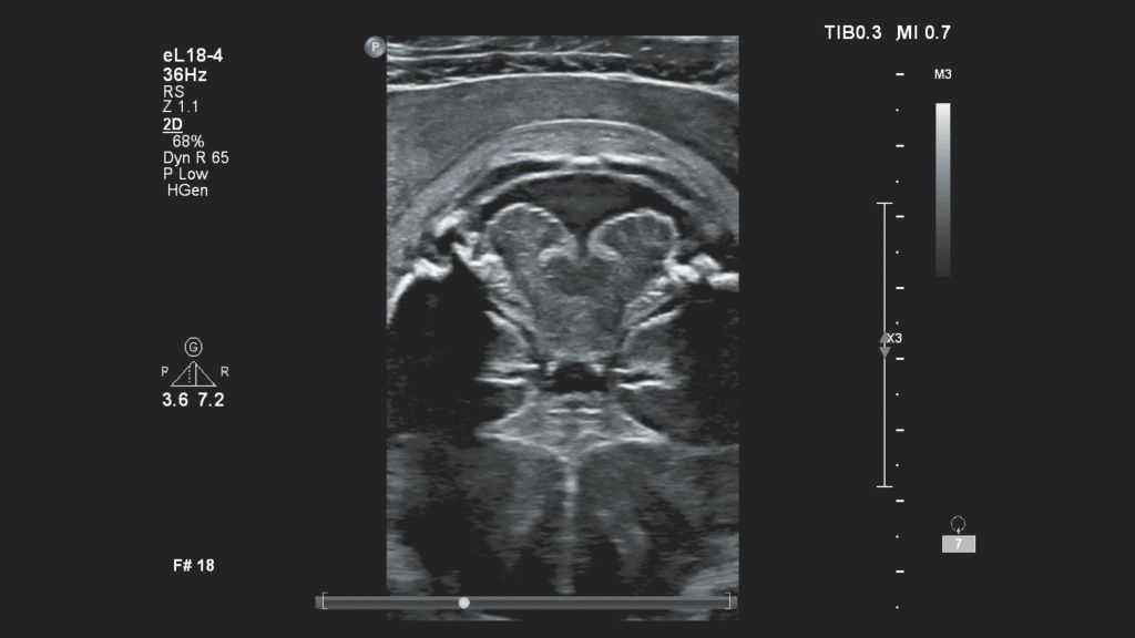 EPIQ Elite fetal brain as shown by the eL18-4