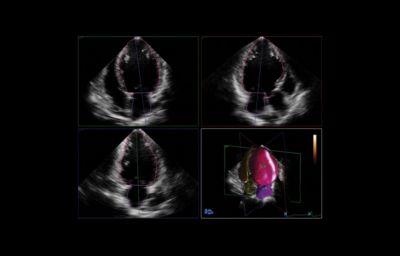 HeartModel clinical study - Philips