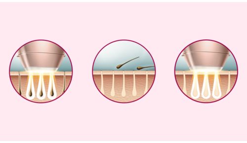 Specjalistyczna technologia IPL do stosowania w domu, opracowana we współpracy z dermatologami