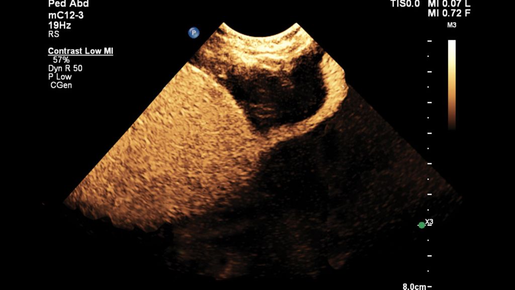Pediatric bladder