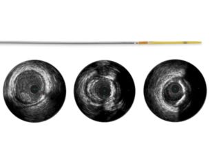 Refinity Rotations-IVUS-Katheter mit kurzer Spitze