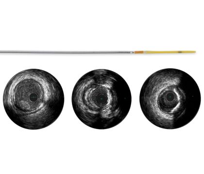 Refinity ST rotational IVUS catheter