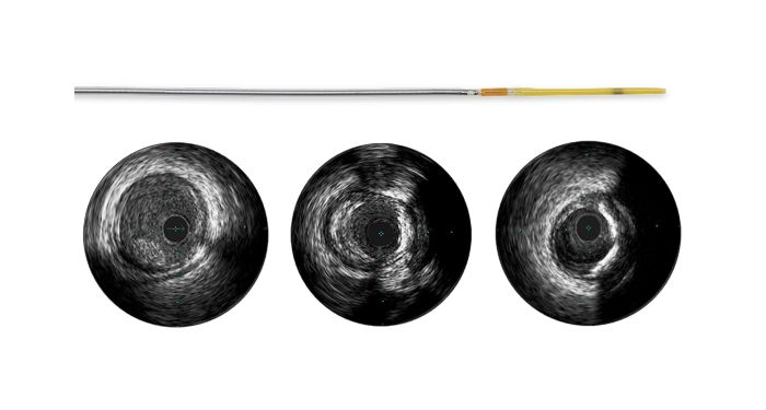 Refinity  Short-tip rotational IVUS catheter