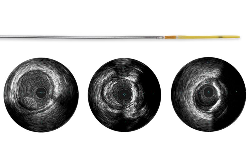 Refinity — Rotational Single Element 45 MHz IVUS Catheter