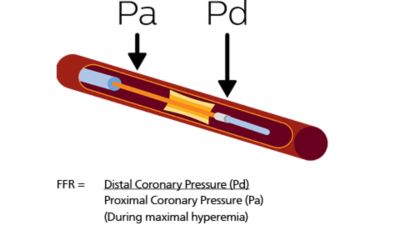 Image about the FFR technology