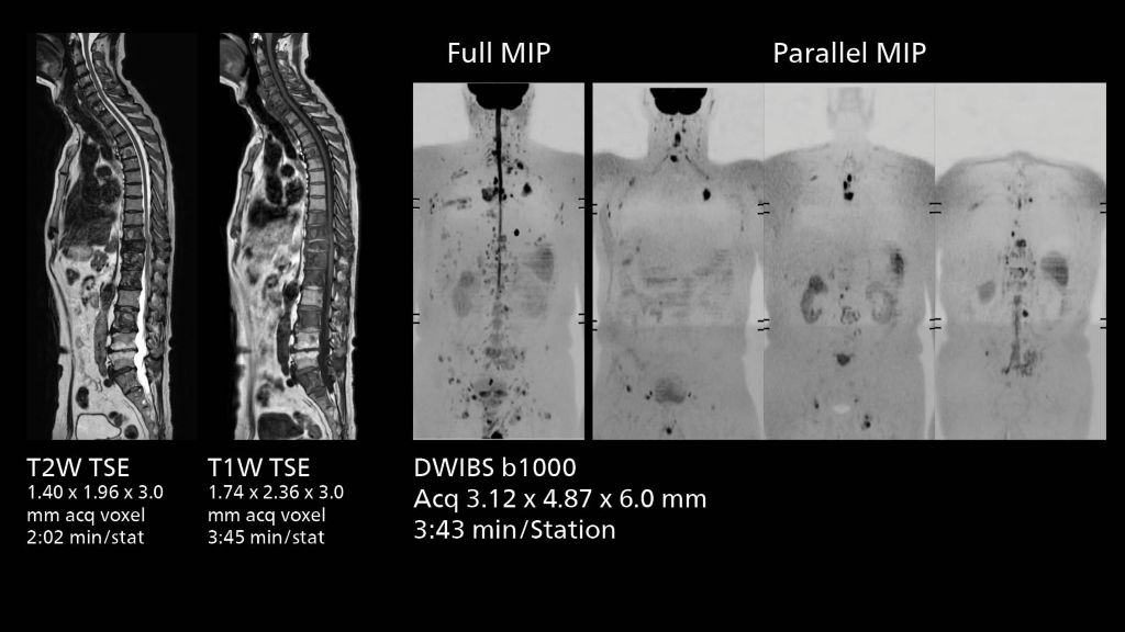 Total spine and DWIBS imaging showing multiple bone metastases  