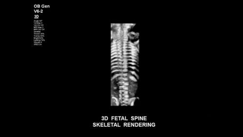 3D fetal spine