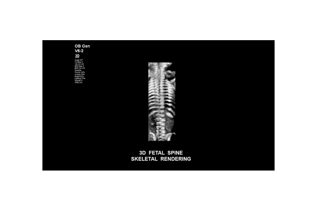 3D fetal spine