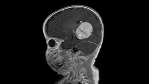 Sagittal T1w 3D (post-gado)