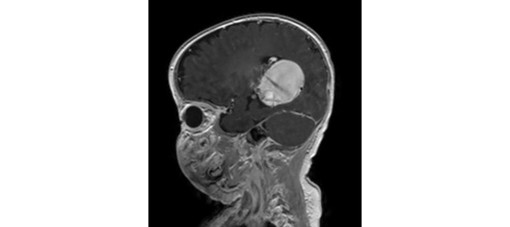 Sagittal T1w 3D (post-gado)