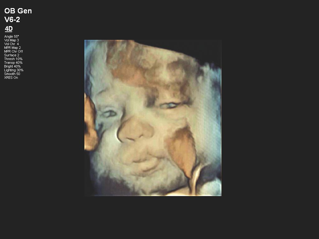 Affiniti 30 ultrasound clinical image obstetric fetal face
