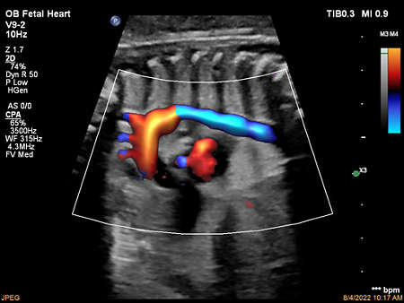 V9-2 Aortic Arch with FlowViewer