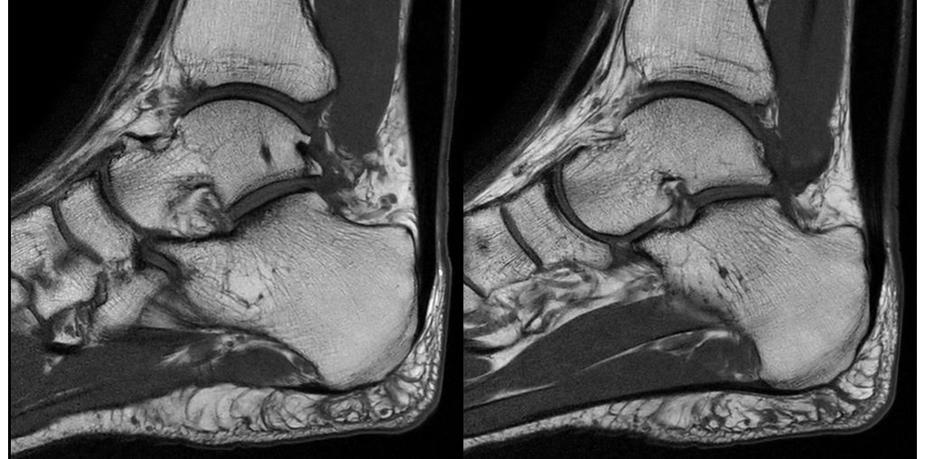 Sagittal T1w - Ankle
