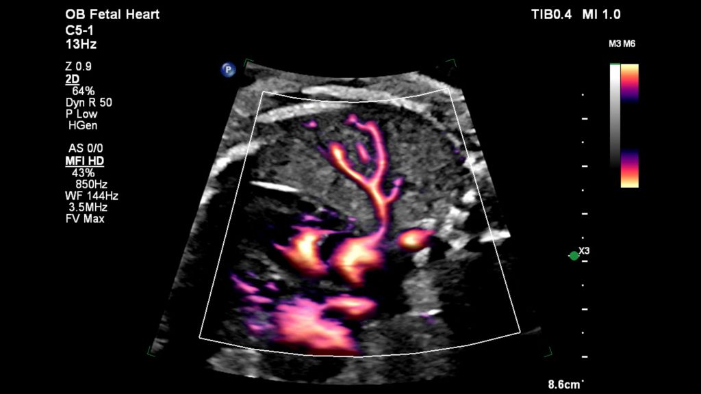 Pulmonary vein and fetal heart MFI with Flow Viewer using C5-1 transducer