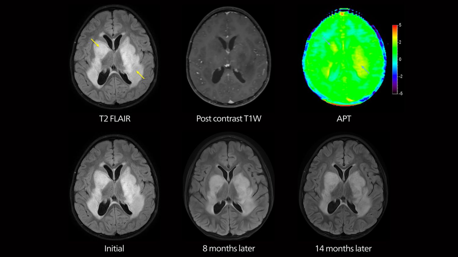 APT MRI of low-grade tumor 