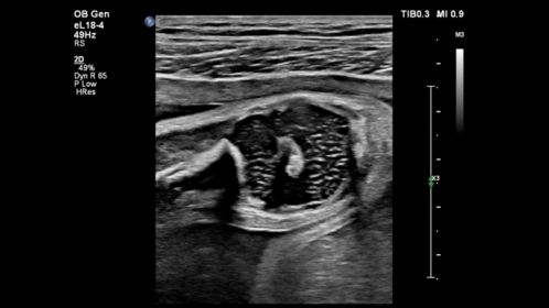Fetal Patella-eL18-4