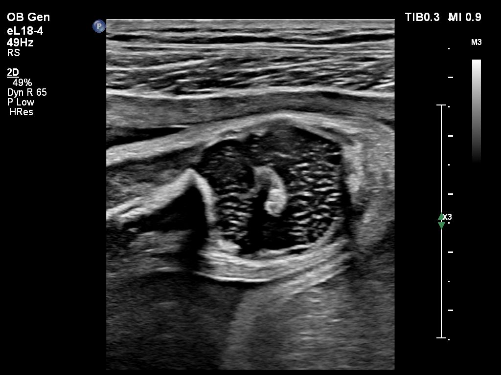 Fetal Patella-eL18-4