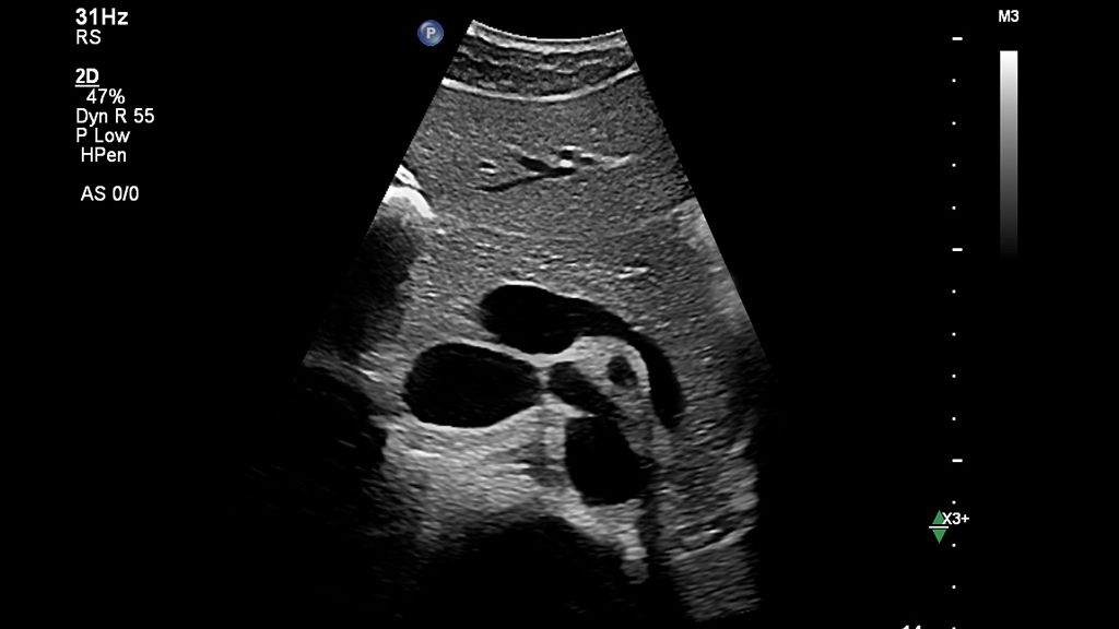 Clinical image using EPIQ Elite and C9-2 transducer showing pancreas 