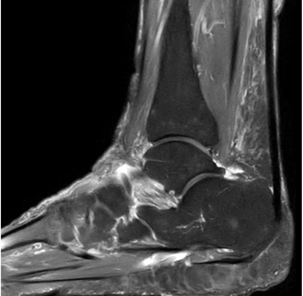 Sagittal PDw SPAIR