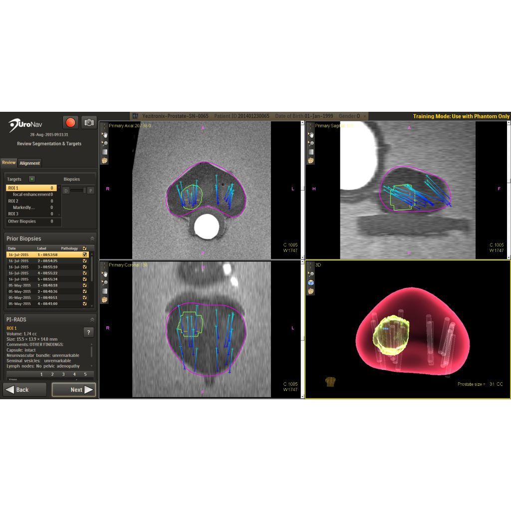 Current/Prior fusion displays points of reference during biopsies