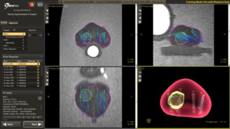 Vorher-Nachher-Fusionsbilder mit Bezugspunkten während der Biopsie