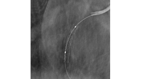 StentBoost enhances stent visualization.