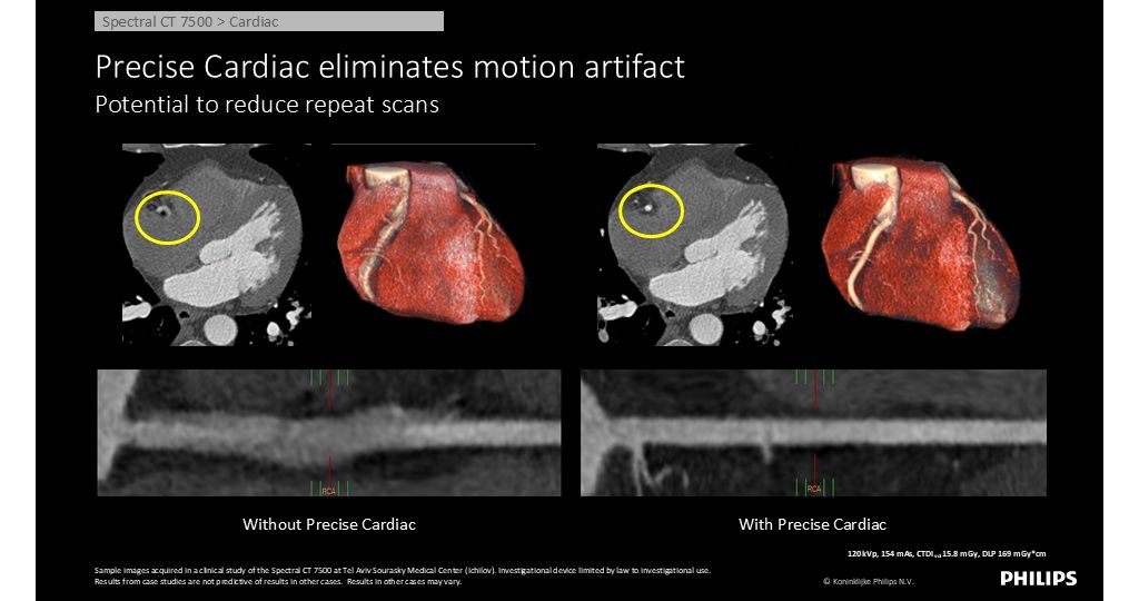 CT Spectral 7500 Cardiac  - Precise Cardiac eliminates motion artifact