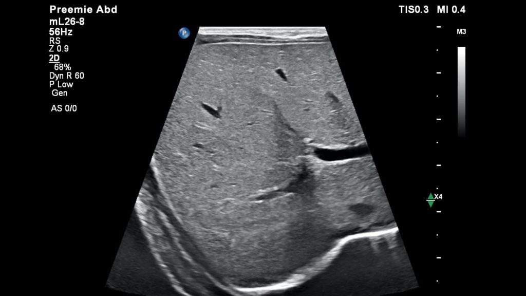 Premature Liver