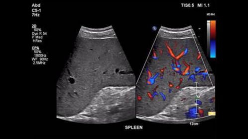 EPIQ ultrasound machine clinical image of a spleen