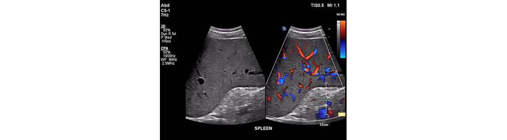 EPIQ ultrasound machine clinical image of a spleen