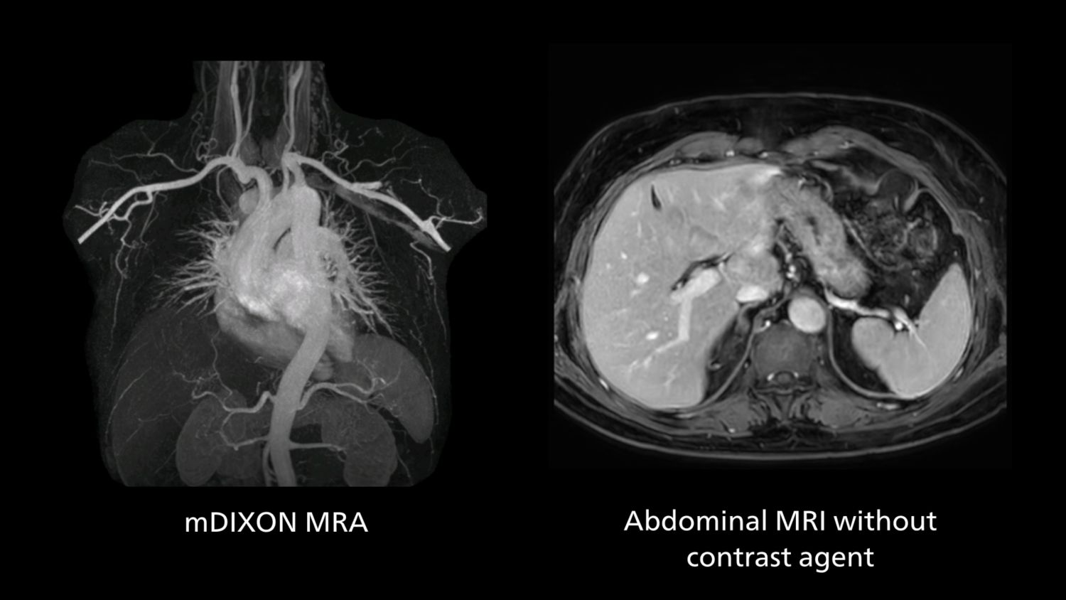 mDIXON MRA and abdominal MRI without contrast agent.