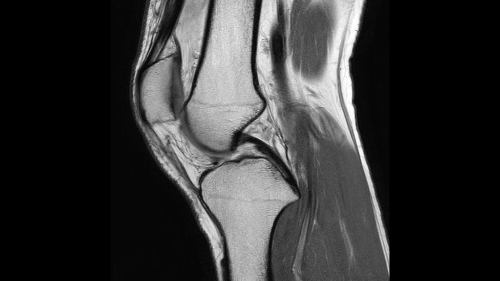 

Knee PDw TSE

