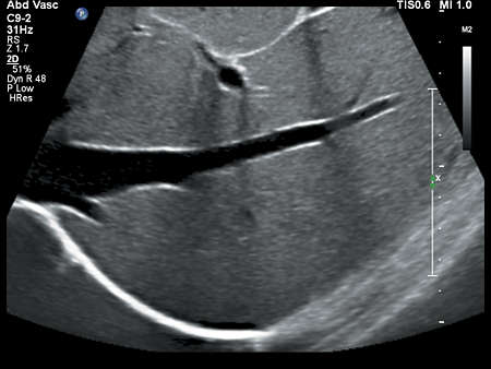 C9-2 Abdomen