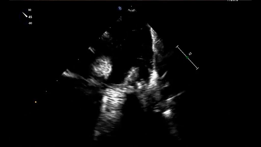 VeriSight PFA ICE image pulmonary veins 