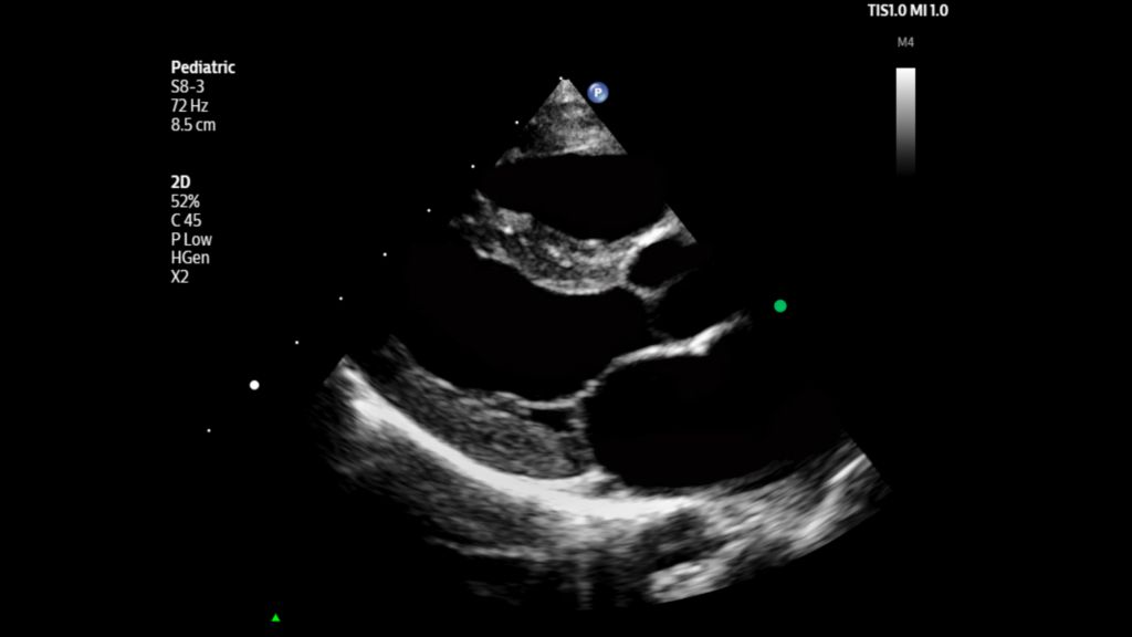 Pediatric parasternal long axis view of left ventricle shown using S8-3 transducer.
