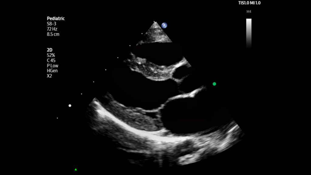 Pediatric parasternal long axis view of left ventricle shown using S8-3 transducer.