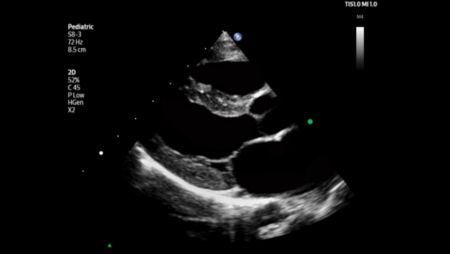 Pediatric parasternal long axis view of left ventricle shown using S8-3 transducer.