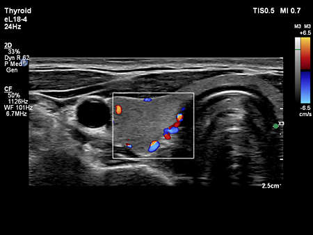 eL18-4 Thyroid