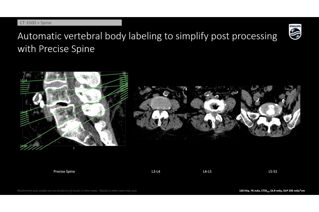 Precise Spine Automatic Disc and Vertebral Body Labeling AI