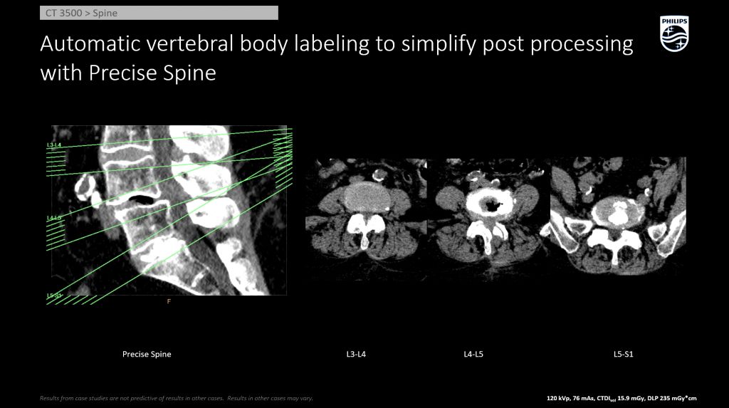 Precise Spine Automatic Disc and Vertebral Body Labeling AI