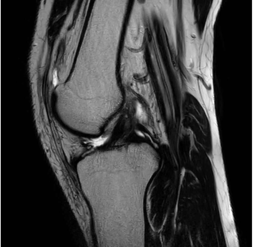 Sagittal T2w TSE 