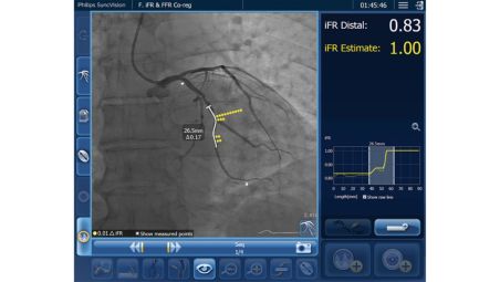 iFR Co-registration helps plan treatment strategy