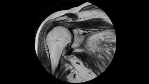 MultiVane XD - Coronal T2w TSE