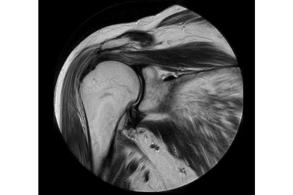 MultiVane XD - Coronal T2w TSE