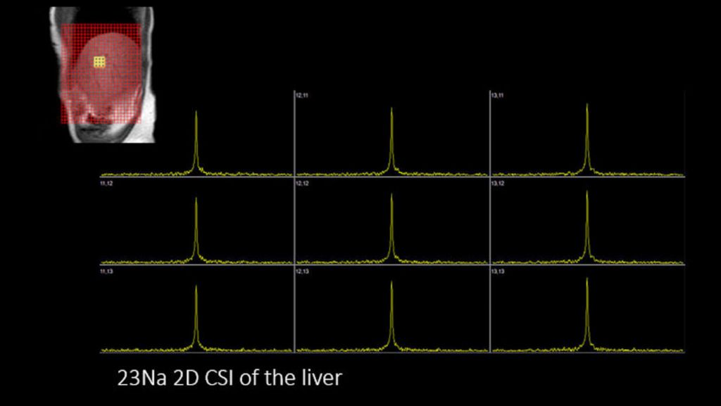 Na140 Liver 2D CSI