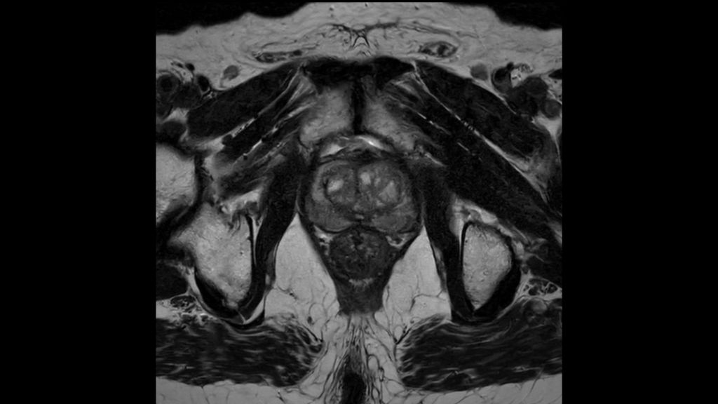 SmartSpeed - Pelvis